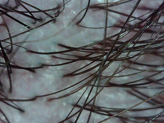 Irritated Scalp, Edinburgh, Scalp Clinic, Scalp Treatment, Edinburgh Irritated Scalp, Edinburgh, Scalp Clinic, Scalp Treatment, Edinburgh