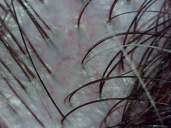 Irritated Scalp, Edinburgh, Scalp Clinic, Scalp Treatment, Edinburgh Irritated Scalp, Edinburgh, Scalp Clinic, Scalp Treatment, Edinburgh