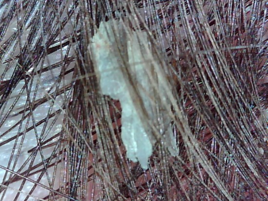 Irritated Scalp, Edinburgh, Scalp Clinic, Scalp Treatment, Edinburgh Irritated Scalp, Edinburgh, Scalp Clinic, Scalp Treatment, Edinburgh