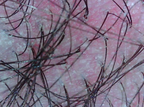 Irritated Scalp, Edinburgh, Scalp Clinic, Scalp Treatment, Edinburgh Irritated Scalp, Edinburgh, Scalp Clinic, Scalp Treatment, Edinburgh