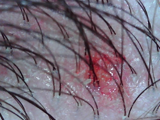 Irritated Scalp, Edinburgh, Scalp Clinic, Scalp Treatment, Edinburgh Irritated Scalp, Edinburgh, Scalp Clinic, Scalp Treatment, Edinburgh