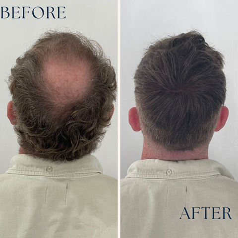 Coming Soon… Male Hair Replacement!
