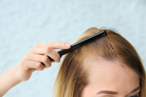 Hair Lossthinning hair in Edinburgh