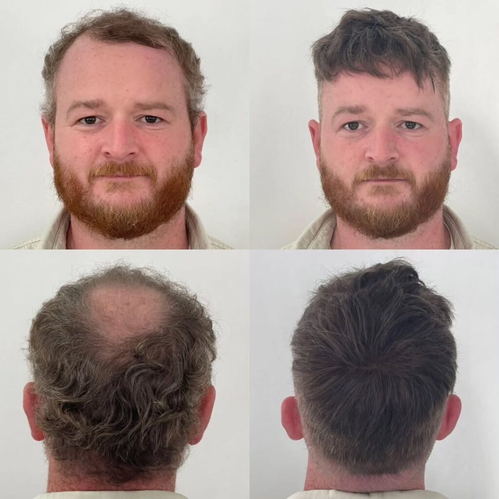Father’s Day Hair System Offer Men's Hair replacement systems offer Edinburgh